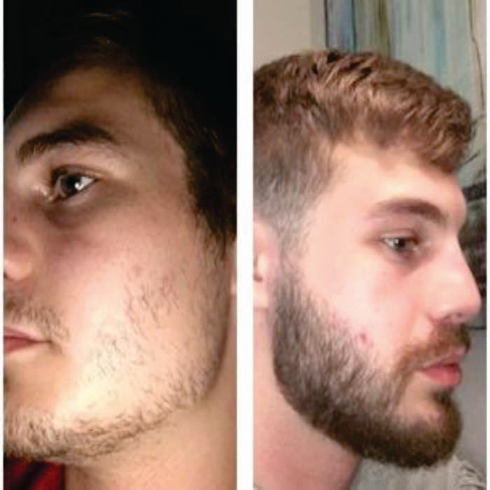 MINOXIDIL 7% con Bergamota Crecimiento Barba y Bigote con Vitamina A y E 1 mes