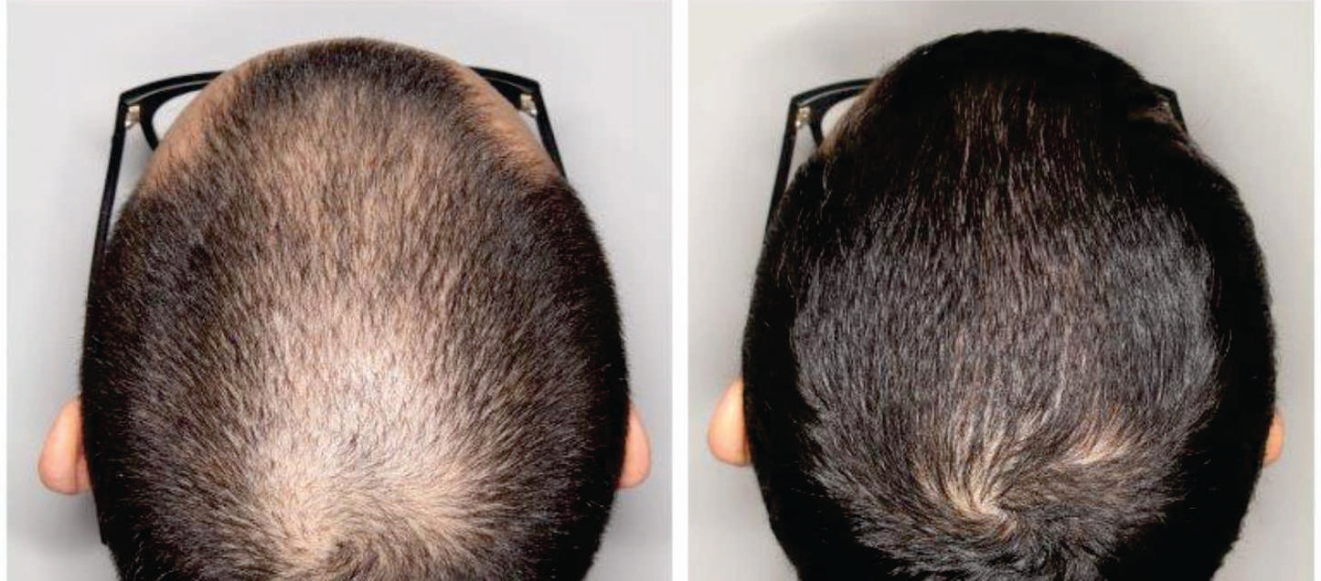 MINOXIDIL 7% Crecimiento de Cabello Fortificado con Biotina y Keratina.