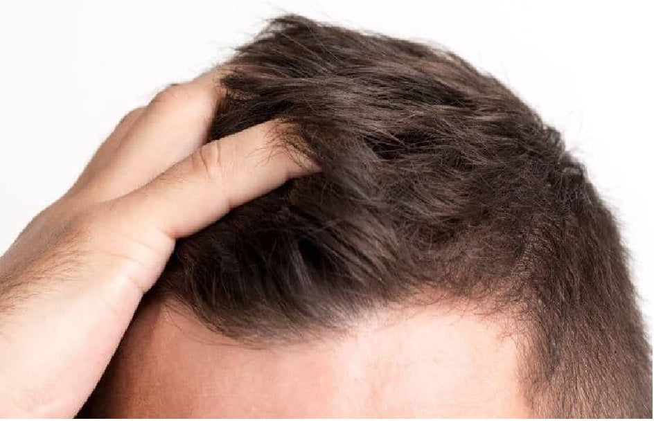 Minoxidil 15% + Finasterida 0.1% + Biotina. Para Cabello Solución Alopecia 1mes